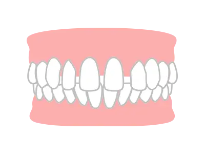 すきっ歯（空隙歯列 / くうげきしれつ）